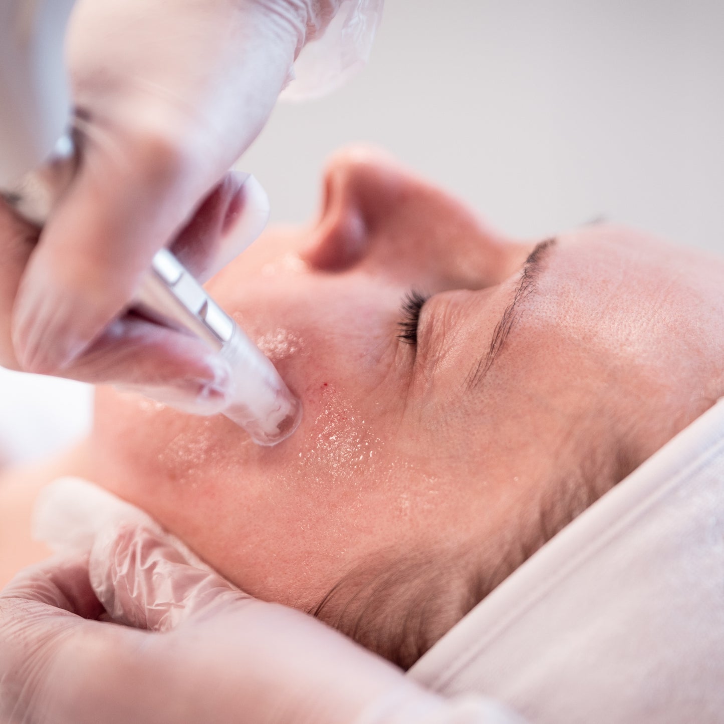XCellarisPRO Twist The Microneedling System for Scar Revision, Deep Repair & Fast Recovery
