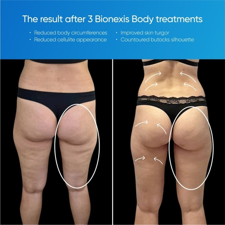 Sistema de contorno Zemits Bionexis Lite Pro