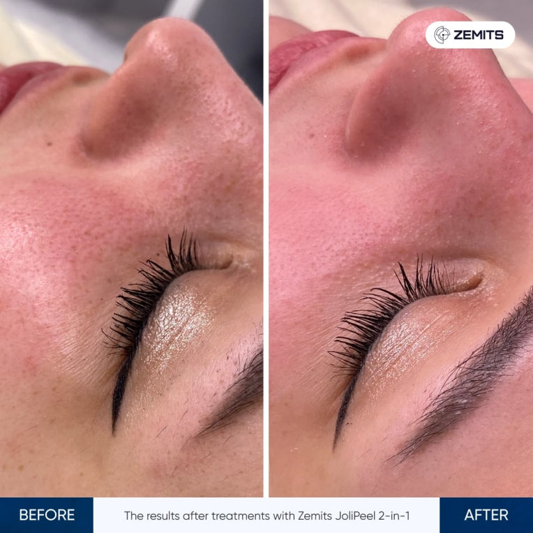 Máquina de microdermoabrasión de diamante Zemits JoliPeel 2 en 1