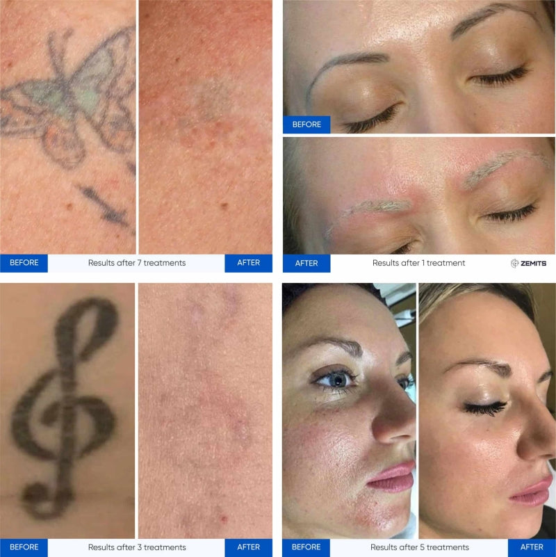 Laser Zemits YAGenix Q-Switched Nd:YAG