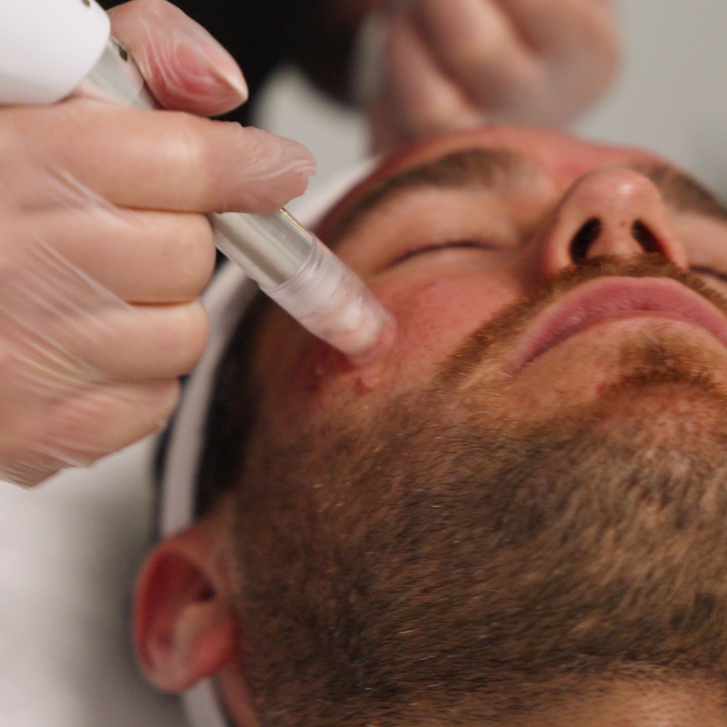 XCellarisPRO Twist The Microneedling System for Scar Revision, Deep Repair & Fast Recovery