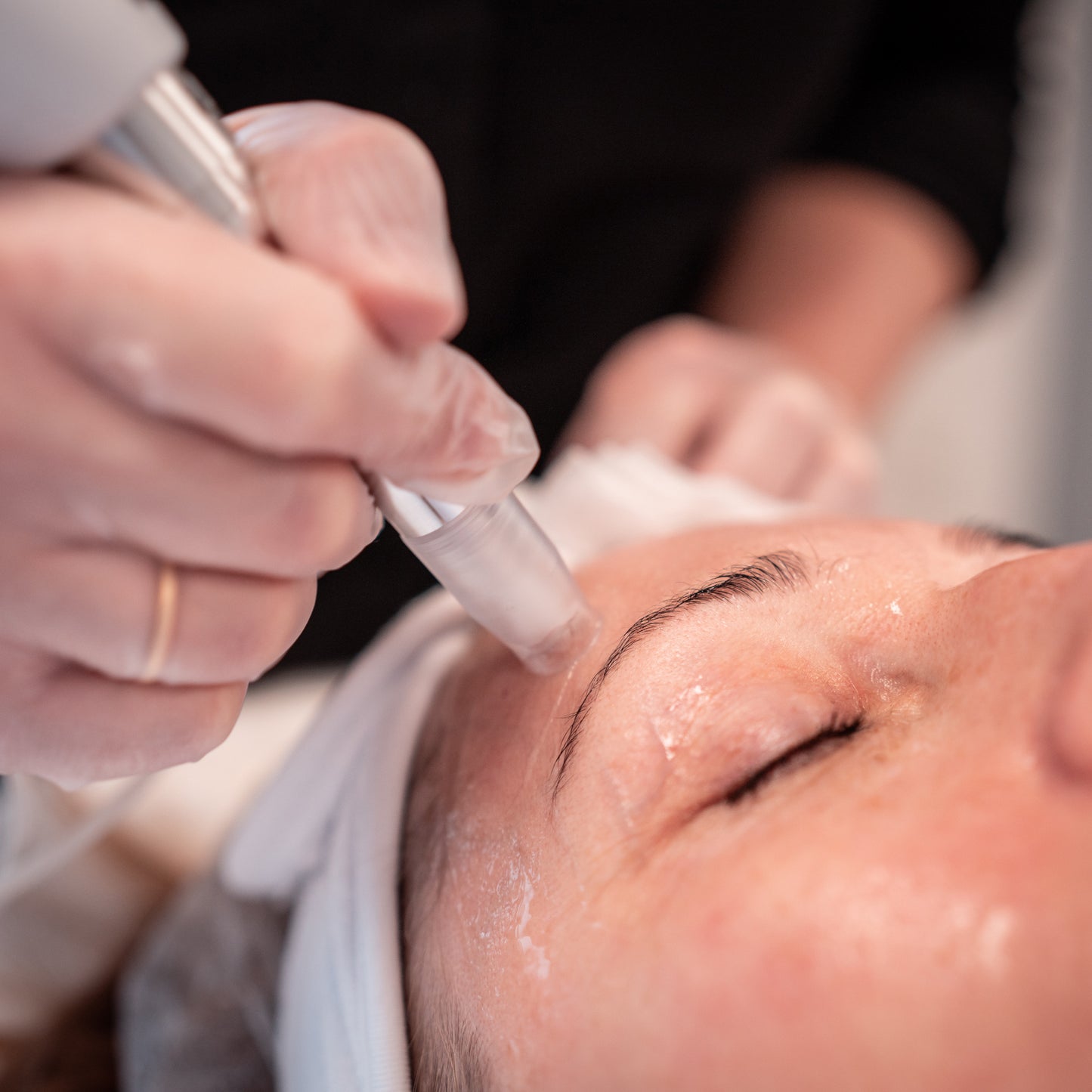XCellarisPRO Twist The Microneedling System for Scar Revision, Deep Repair & Fast Recovery