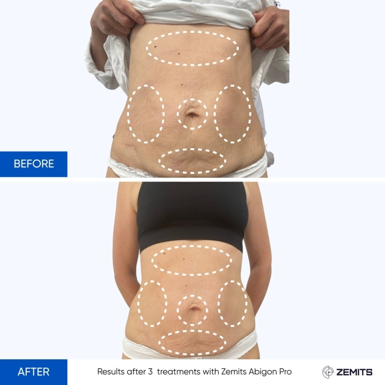Zemits Abigon Pro Ultimate Body Remodeling Slimming System