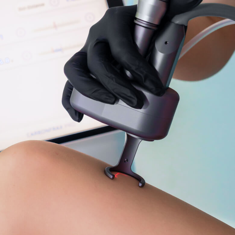 Zemits CarbonFrax Pro Next-Generation Precision Fractional CO for Face, Body & Intimate